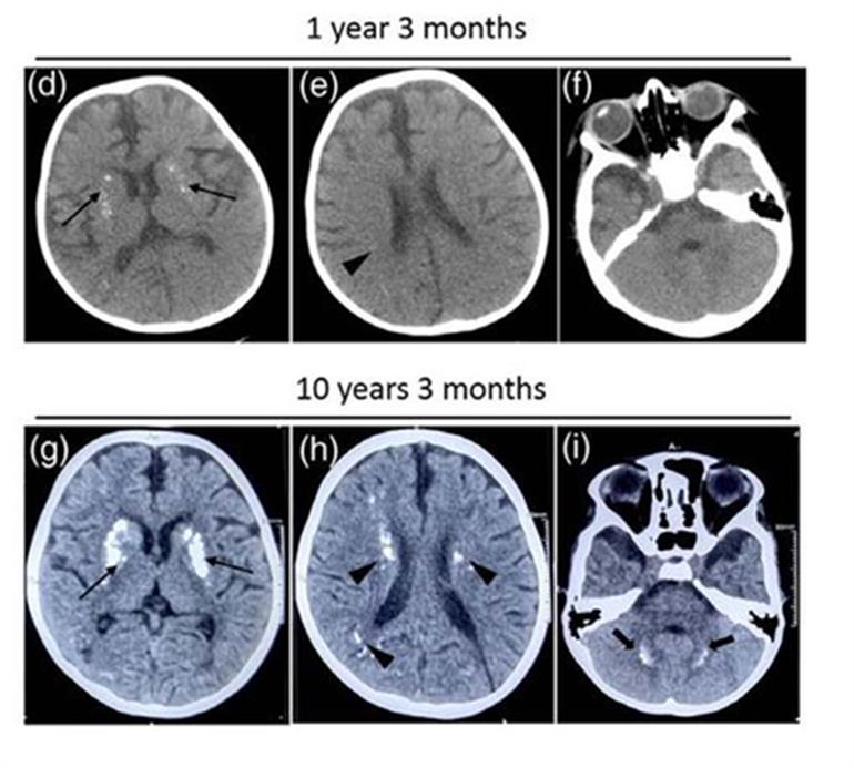 भारतीय शोधकर्ताओं ने बच्चों में बार-बार होने वाली तंत्रिका संबंधी गिरावट से जुड़े एक दुर्लभ जीन उत्परिवर्तन की खोज की है