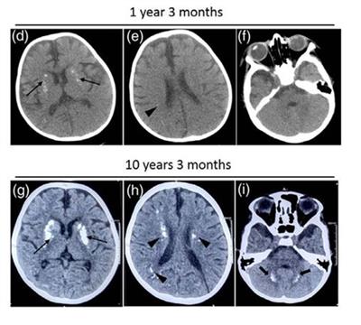 भारतीय शोधकर्ताओं ने बच्चों में बार-बार होने वाली तंत्रिका संबंधी गिरावट से जुड़े एक दुर्लभ जीन उत्परिवर्तन की खोज की है