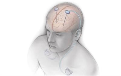 AIIMS ने पार्किंसन, मूवमेंट डिसऑर्डर के लिए भारत की पहली डीप ब्रेन स्टिमुलेशन वर्कशॉप आयोजित की
