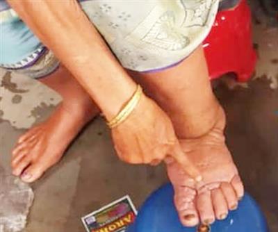 गुजरात में 10 फरवरी से फाइलेरिया के खिलाफ सामूहिक औषधि वितरण कार्यक्रम शुरू होगा, जिसमें 5.48 लाख लोगों को शामिल किया जाएगा।